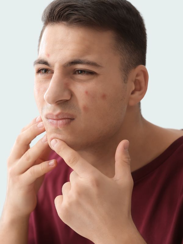 acne-and-acne-scar-management